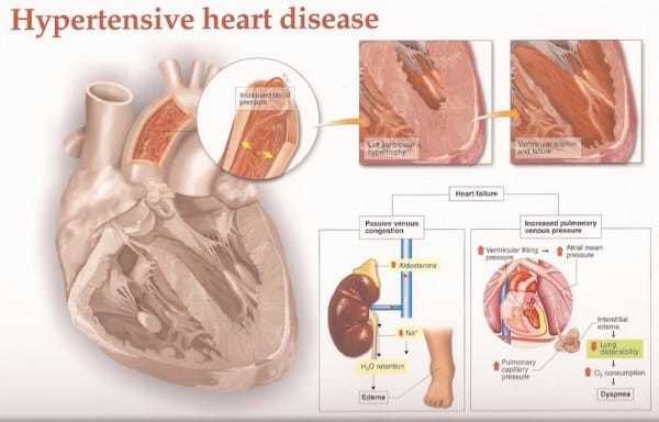 Uncovering a Hidden Disease